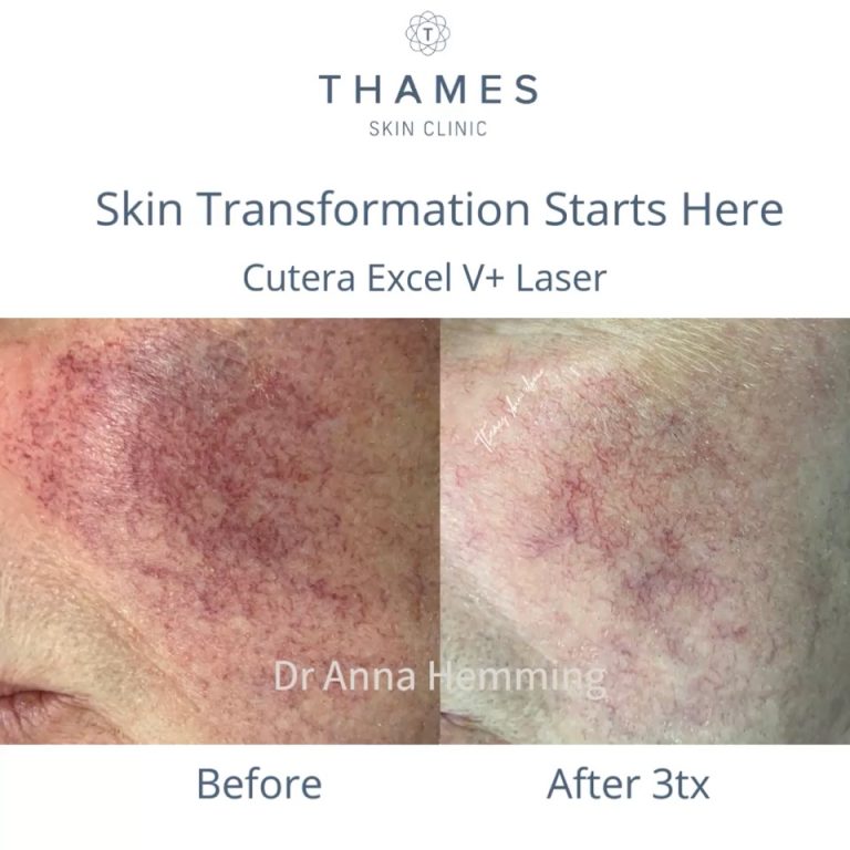 Cutera Excel V+ Laser treatment for facial veins and rosacea