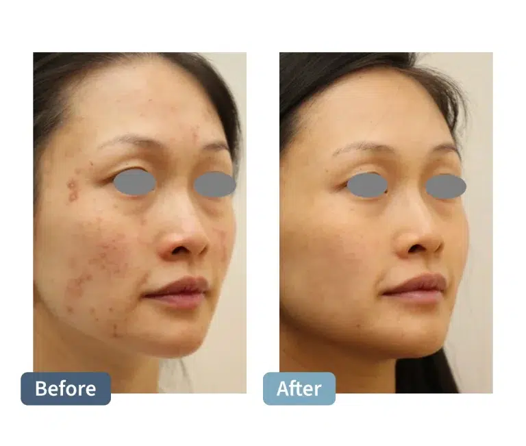 Fotana Acne and Acne Scars
