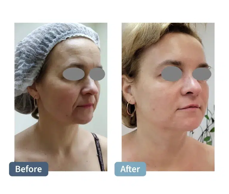 Fotana Face Lift Before and After