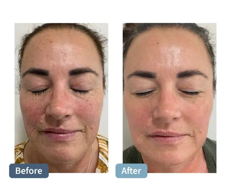 Fotana Face Lift Before and After