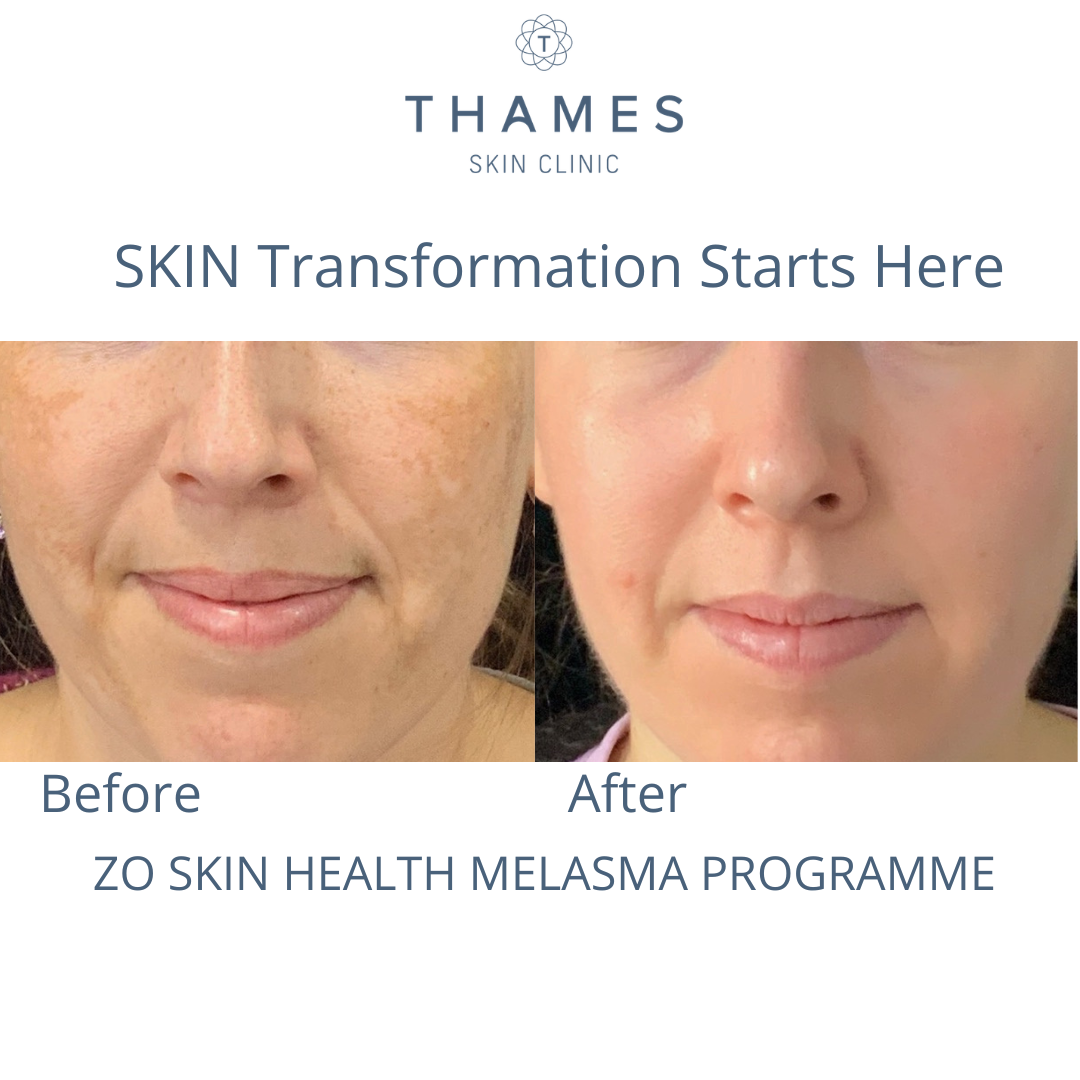 Melasma treatment at Thames Skin Clinic under Dr Anna Hemming